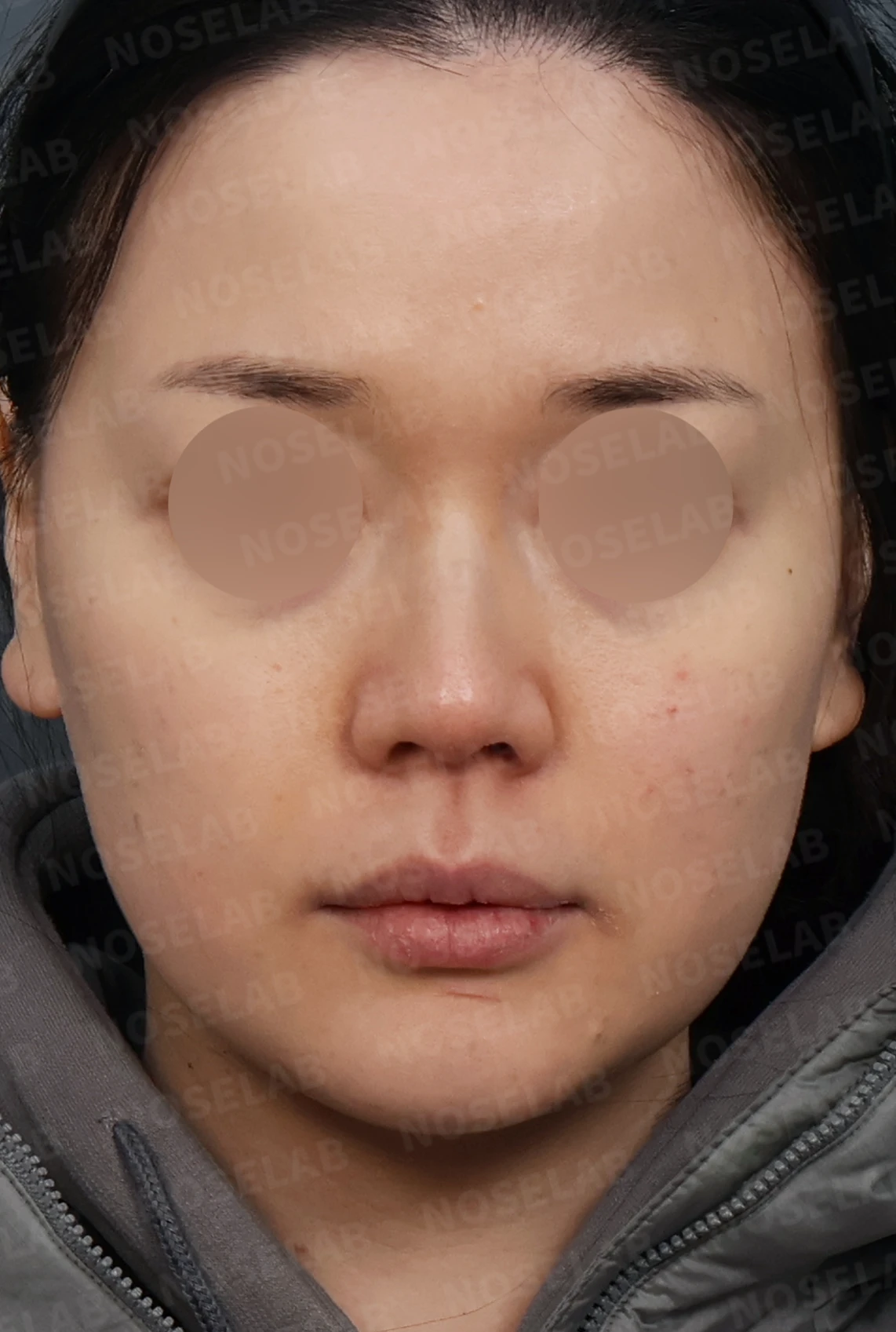 매부리코 교정, 처진 코끝을 오똑하게 바꾸는 비개방 코성형 — 디자인 상담 정면, 좌측 측면, 비스듬한 측면 사진입니다.