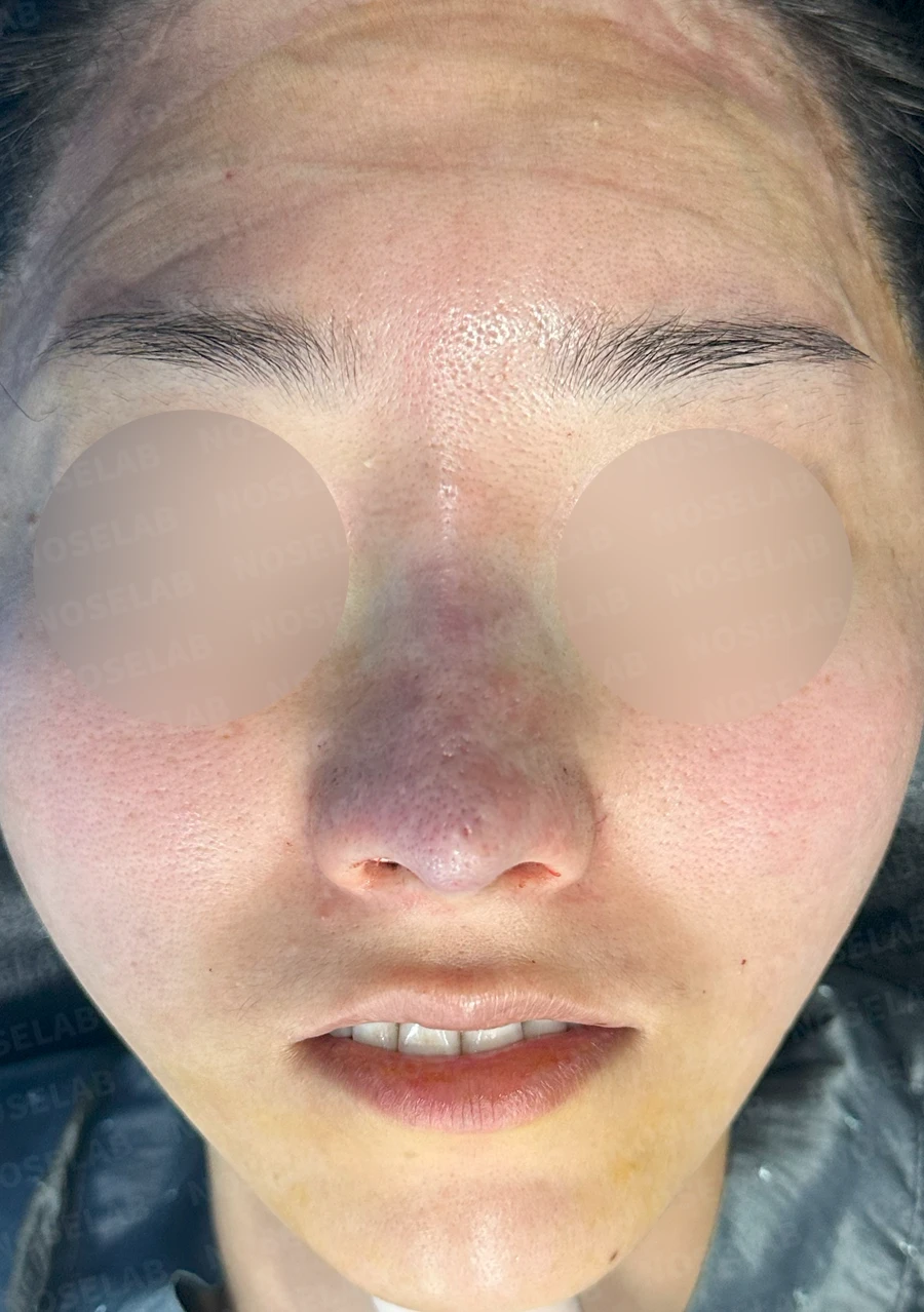 외측절골 후 코막힘과 비대칭을 살펴보는 교정 방법 — 수술 직후 0일 정면, 비스듬한 측면, 측면 직후 사진은 부기가 있는 상태로 최종 결과와 다를 수 있습니다.