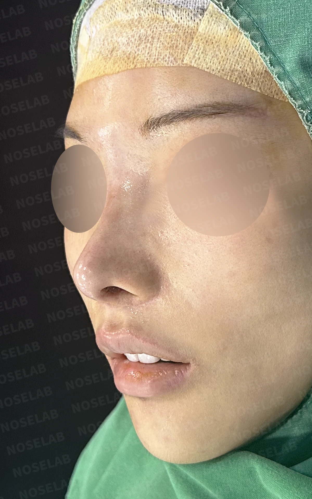 콧대 반영구 필러가 남기는 변화와 제거 후 비중격 재건 — 수술 전 / 수술 직후 0일 직후 사진은 부기가 있는 상태로 최종 결과와 다를 수 있습니다.