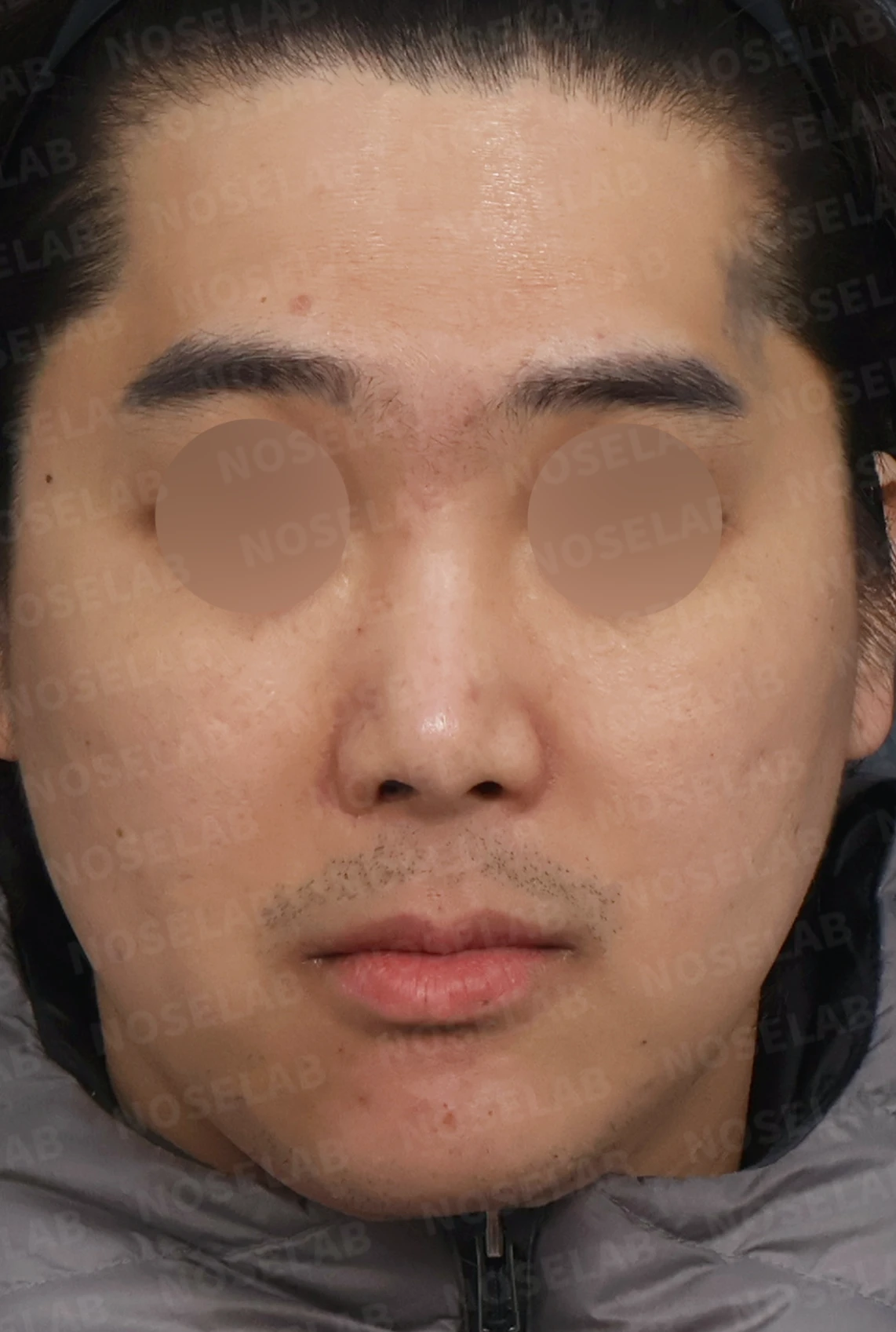 휜코 교정과 비공 비대칭, 자가늑연골로 바로잡은 코재수술 — 디자인 상담 정면, 좌측 측면, 비스듬한 측면 사진입니다.