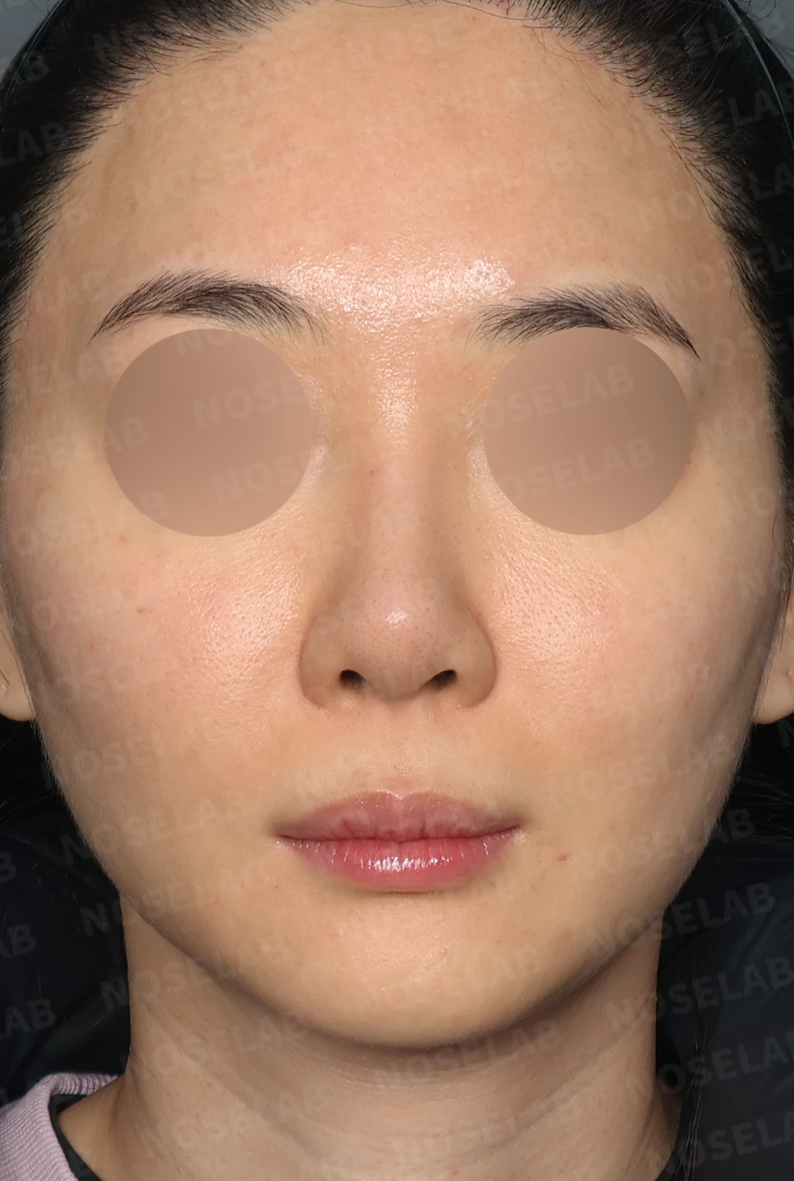 L자 보형물 제거 후 자가 늑연골로 코끝을 교정한 코재수술 — 디자인 상담 정면, 좌측 측면, 비스듬한 측면 사진