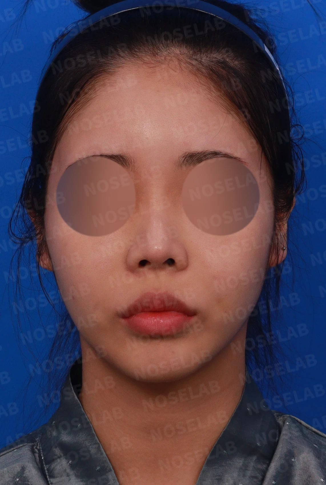 적절하지 않은 L자 실리콘 개선 - 안전한 구조로 재건 후기 — 디자인 상담 정면, 좌측 측면, 비스듬한 측면 사진