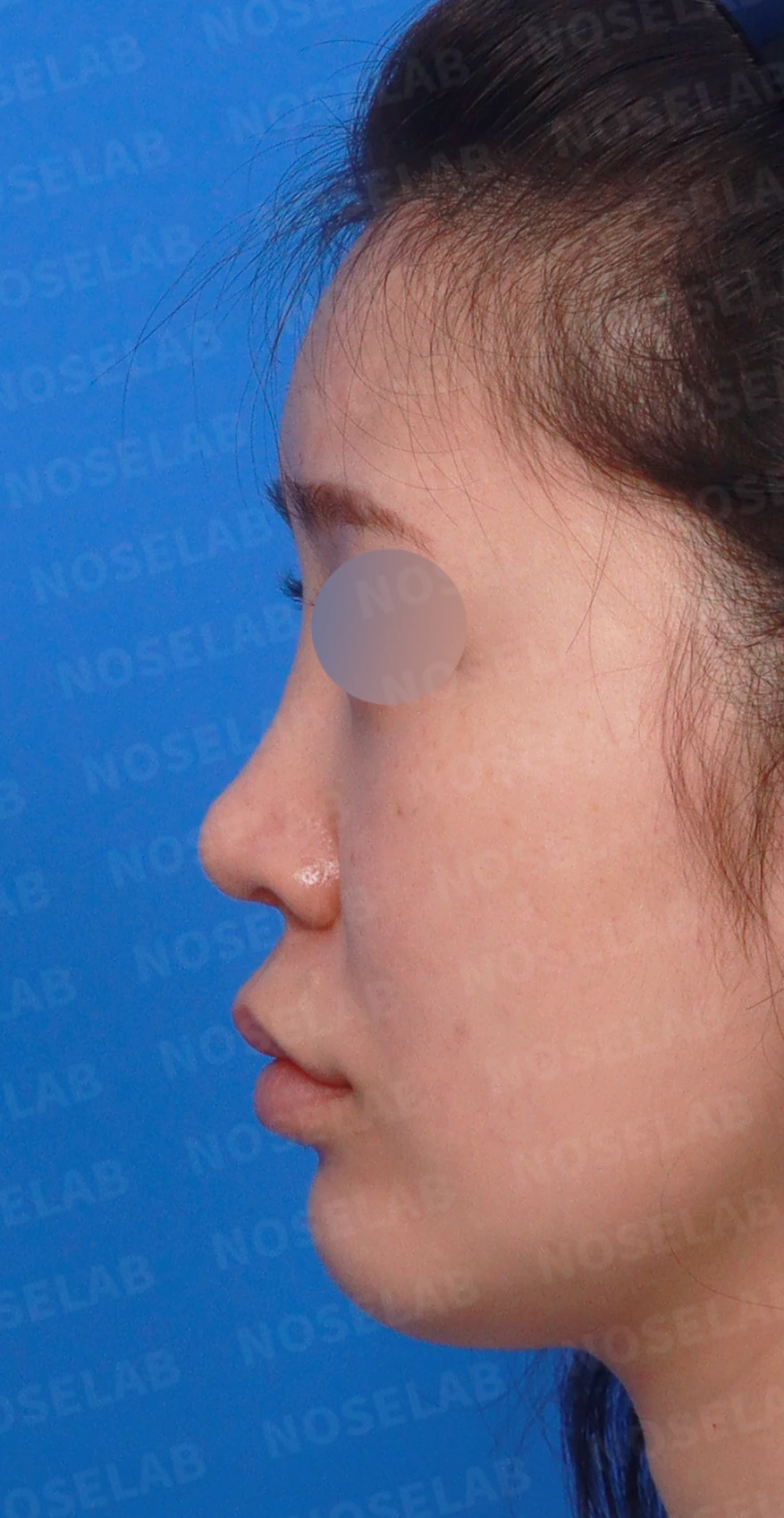 연골 노출 복원과 날개 연골 재건으로 안전하고 자연스러운 코 — 디자인 상담 정면, 좌측 측면, 비스듬한 측면 사진입니다.