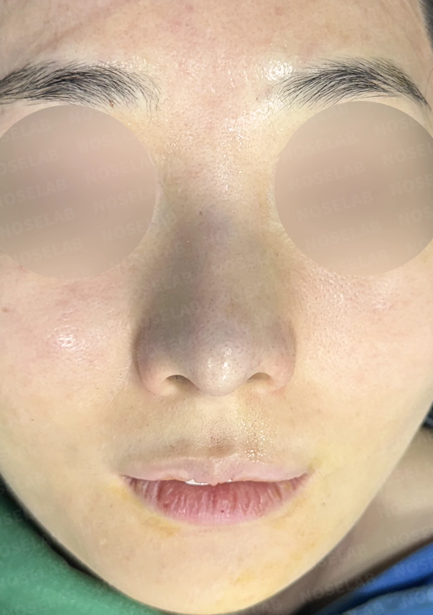 L자 보형물 제거 후 자가 늑연골로 코끝을 교정한 코재수술 — 직후 정면, 비스듬한 측면, 측면 사진