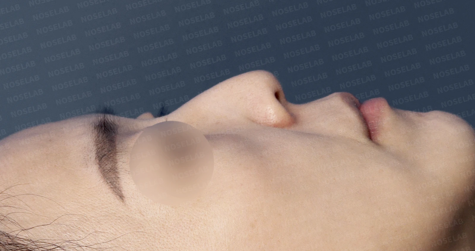 들창코, 매부리코, 휜코까지 한번에 완벽 교정! — 수술전(좌) 수술직후(우)