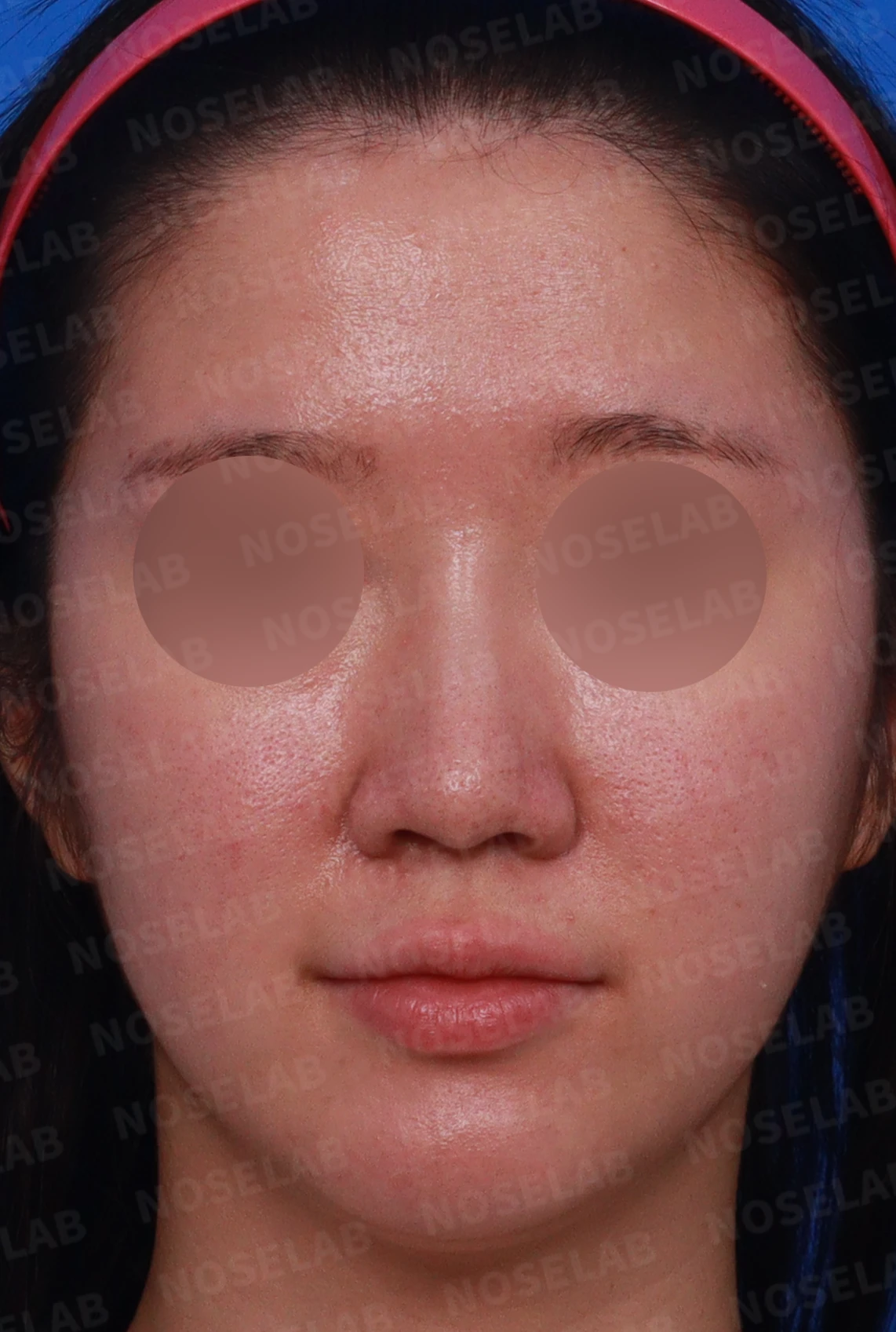 비중격 연골이 손상되면 코끝이 처지고 비주가 함몰되는 이유 — 디자인 상담 정면, 비스듬한 측면 사진, 좌측 측면
