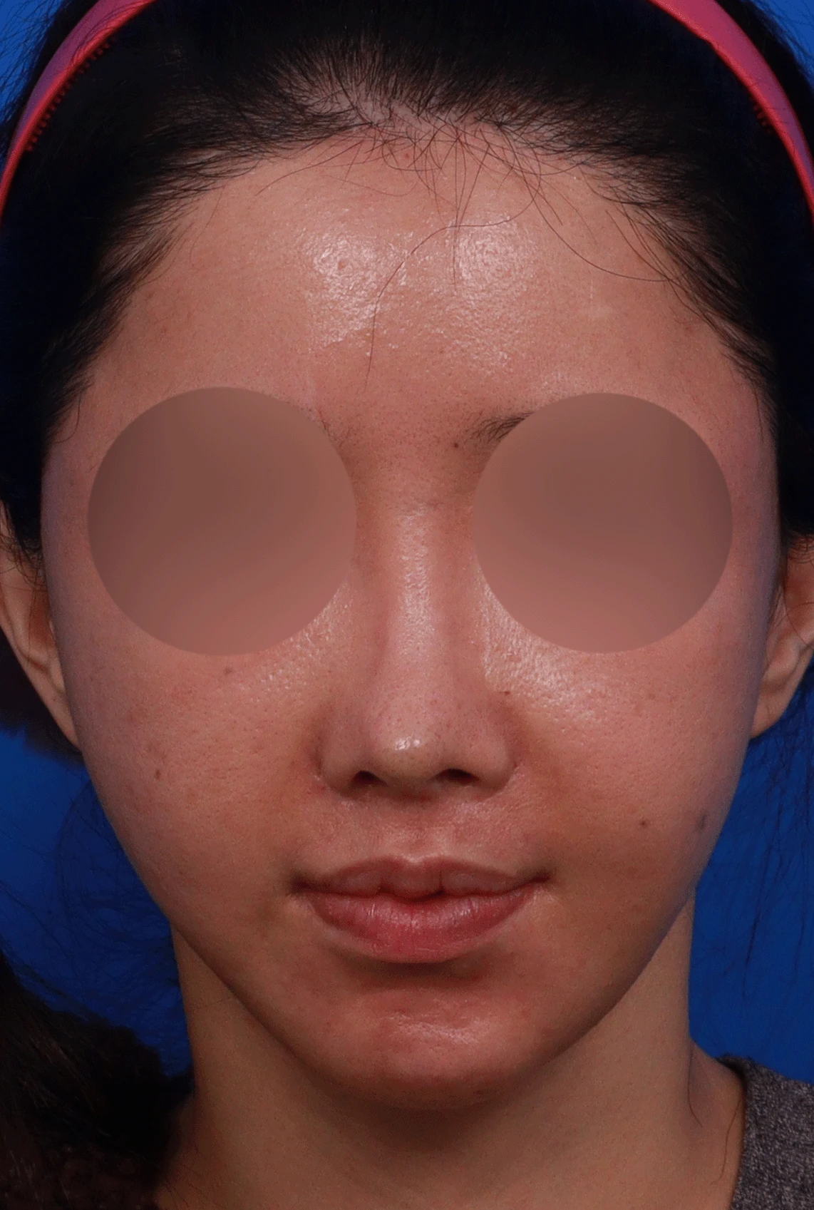 다수 재수술 후 인공진피 흡수와 비중격 손상 재건 사례 — 디자인 상담 정면 , 좌측 측면, 비스듬한 측면 사진