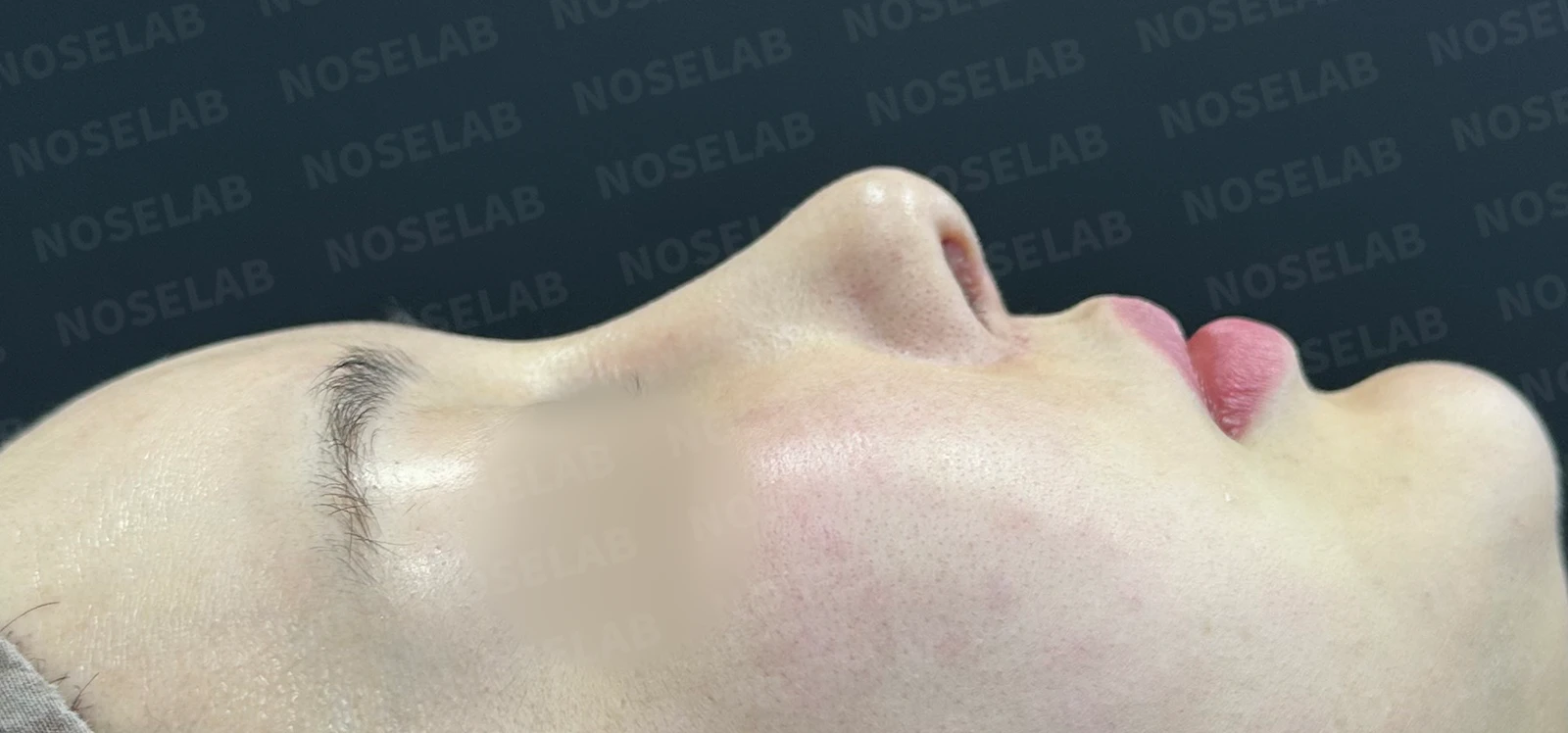 수술 후 14일 조기 교정에서 확인할 점 — 수술 전 / 수술 직후 0일 직후 사진은 부기가 있는 상태로 최종 결과와 다를 수 있습니다.