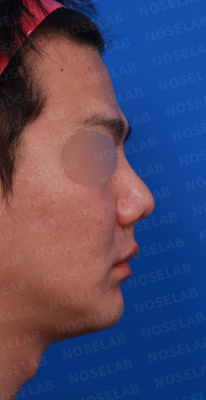 콧구멍 비대칭과 들린 코가 함께 생기는 이유, 늑연골 재건은 어떻게 하나 — 디자인 상담 우측 비스듬한 측면, 측면, 비공 사진