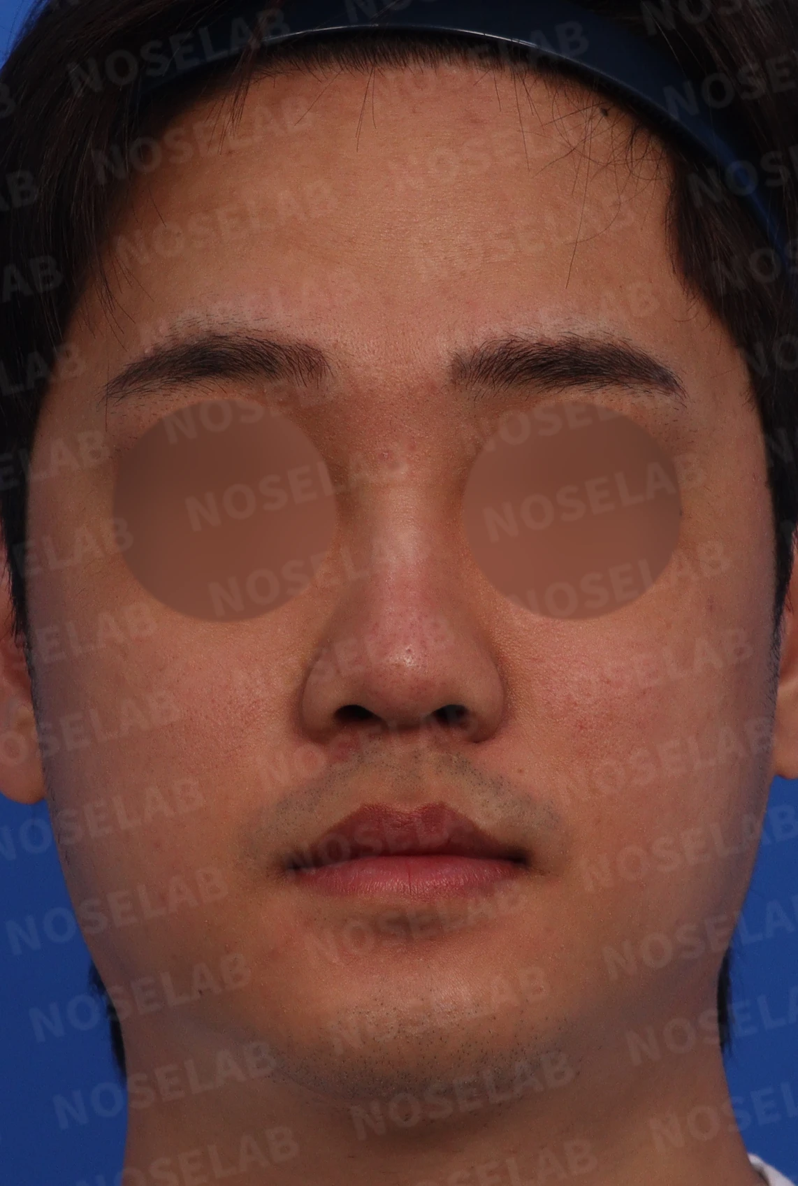 실리콘 부작용과 퍼진 코의 재수술 방법 — 수술전 디자인 상담을 위해 촬영한 정면, 비스듬한 측면, 측면 사진입니다.
