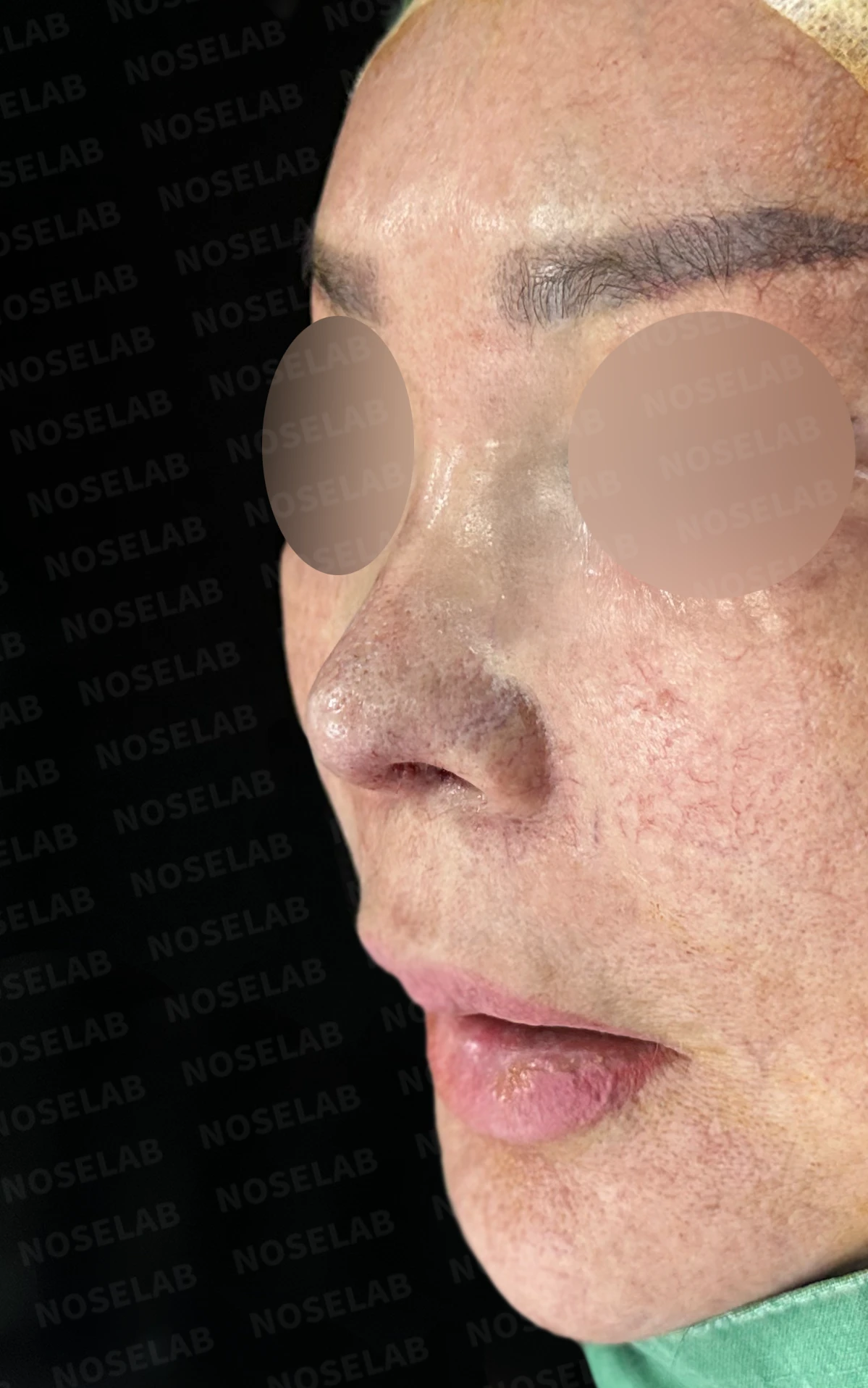 보형물 염증으로 손상된 코, 휴식기 후 기증늑연골로 안전하게 재건한 코재수술 — 직후 정면, 비스듬한 측면, 측면 사진입니다.