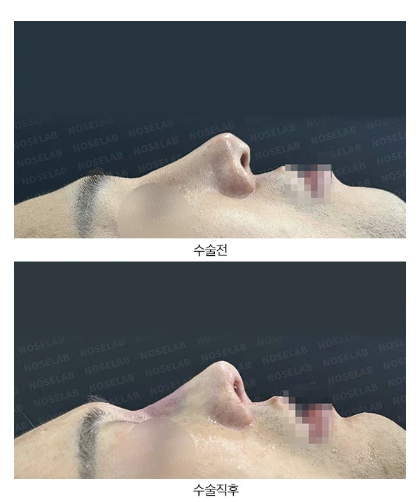 만성 이물 반응 + 이물질제거 + 긴 코 교정 재수술(자가늑연골) — 전후 비교