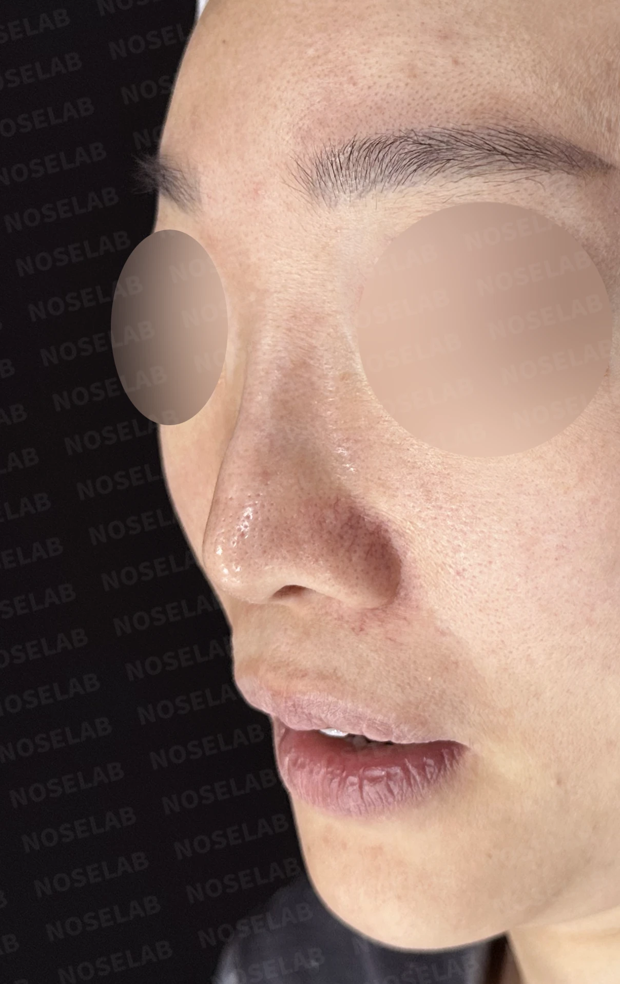 비중격이 한쪽으로 무너지면 코가 휘고 숨이 막히는 이유, 자가늑연골 재건 방법 — 수술 전 / 수술 직후 0일 직후 사진은 부기가 있는 상태로 최종 결과와 다를 수 있습니다.