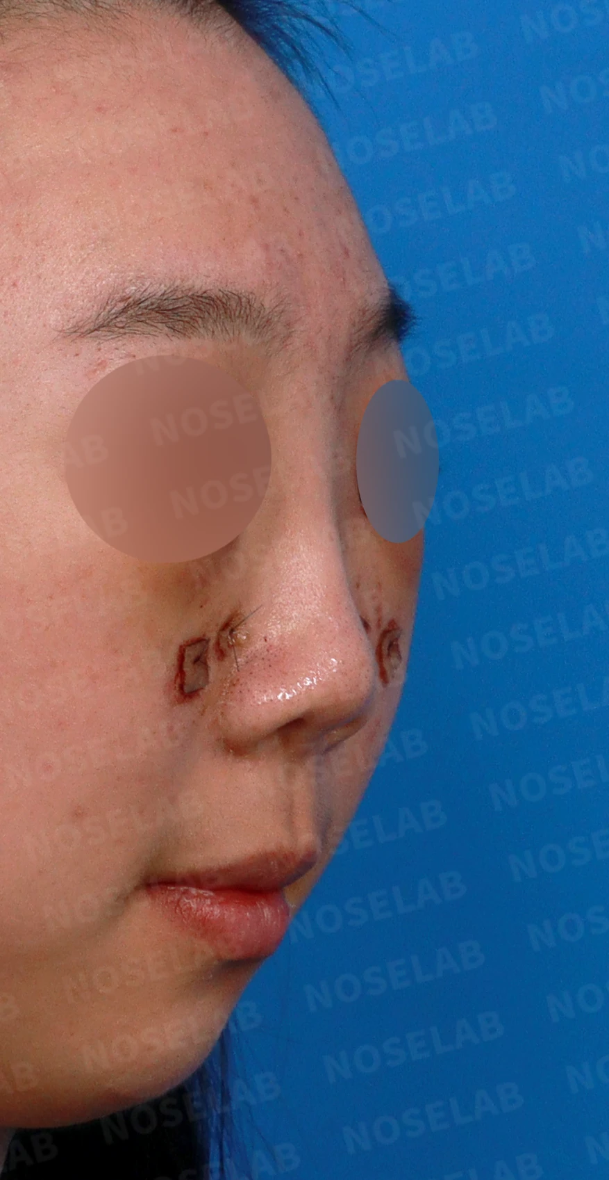 메드포어로 손상된 비중격, 자가늑연골로 완벽하게 재건하다 — 디자인 상담 우측 측면, 비스듬한 측면, 비공 사진입니다.