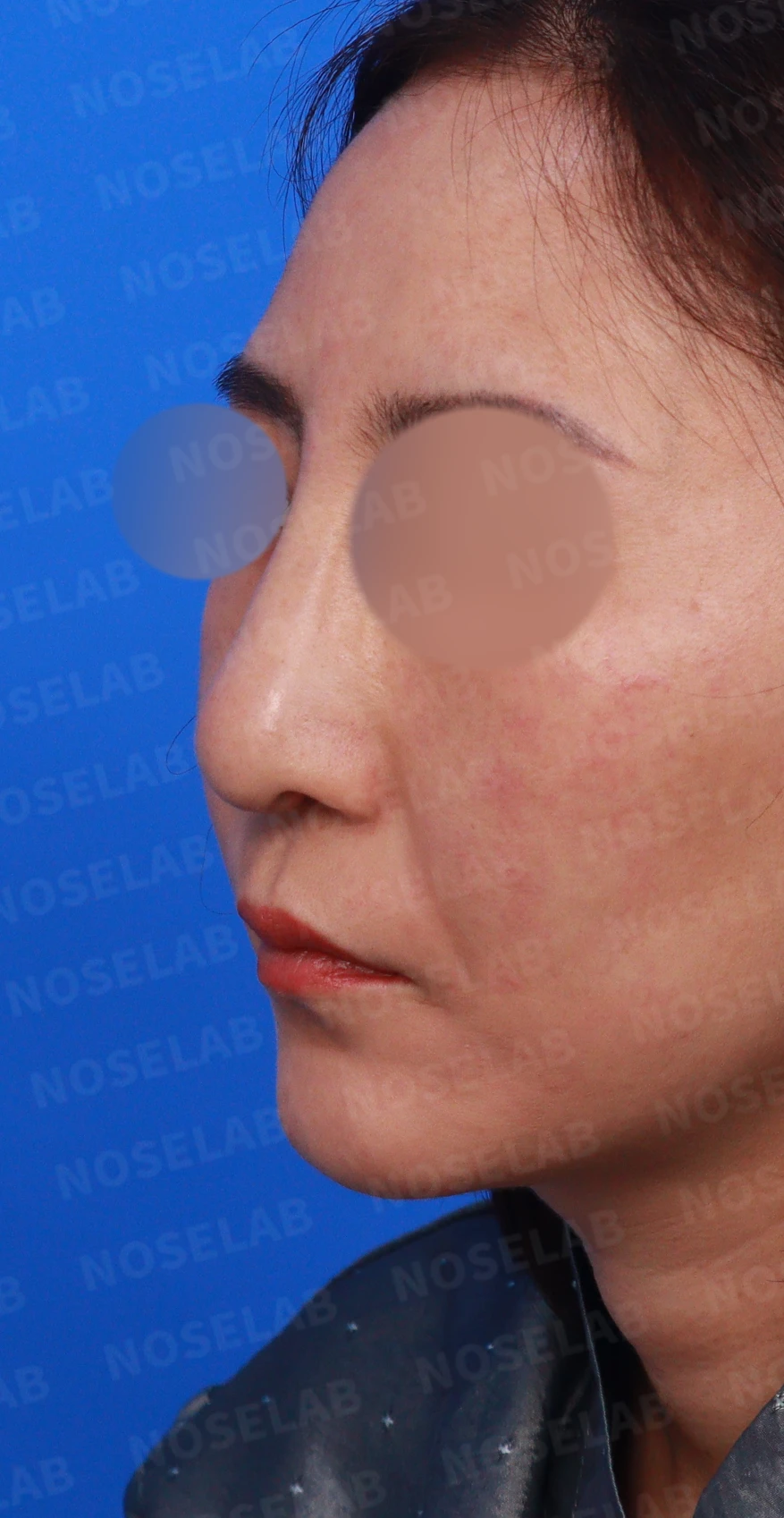 무자격 불법 주사 뒤 콧구멍이 좁아지는 이유와 제거·재건 방법 — 디자인 상담 정면, 좌측 측면, 비스듬한 측면 사진입니다.