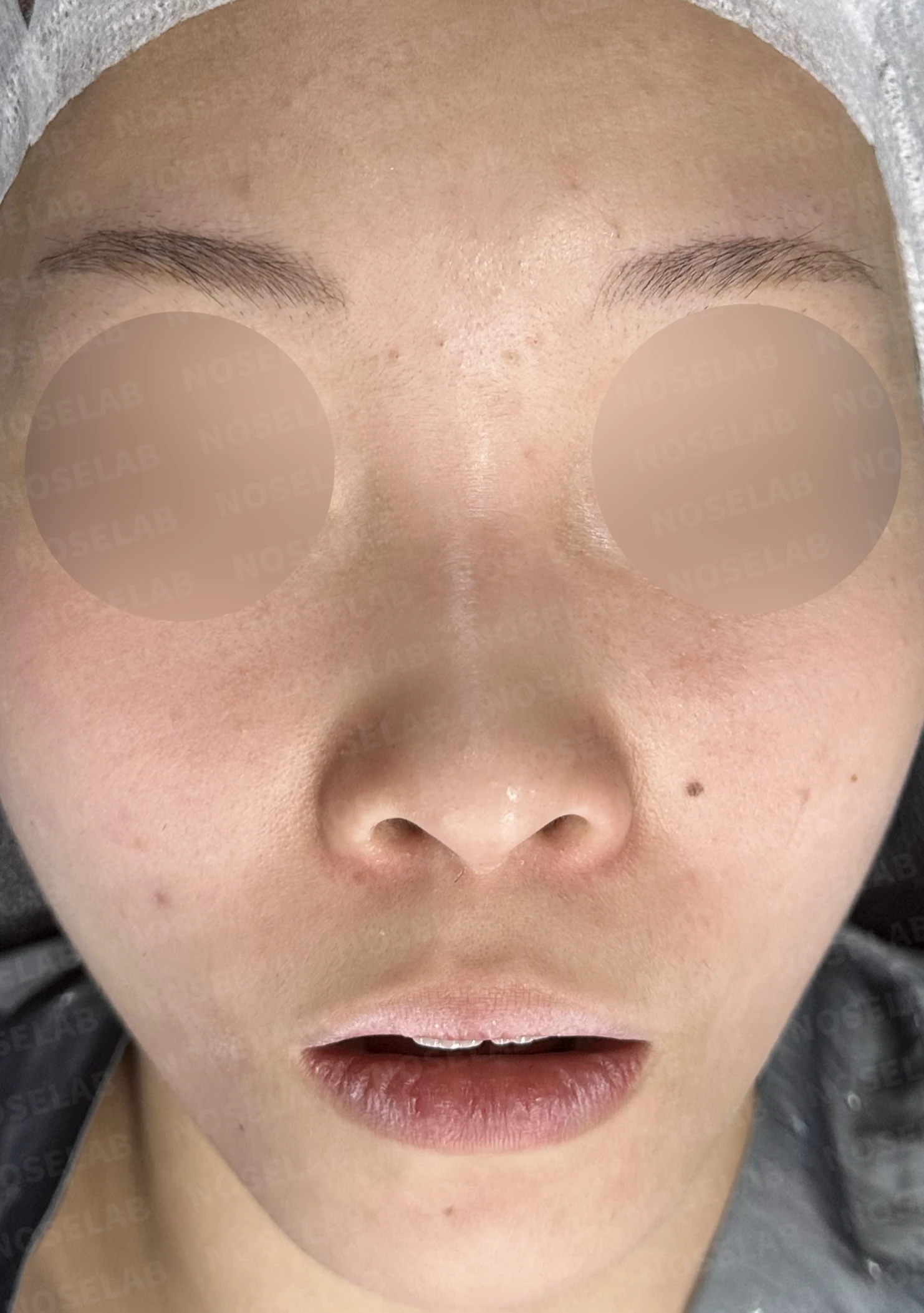 낮고 퍼진 코, 기증늑연골과 실리콘 보형물로 자연스러운 코 라인 완성 — 전(좌) 직후(후)