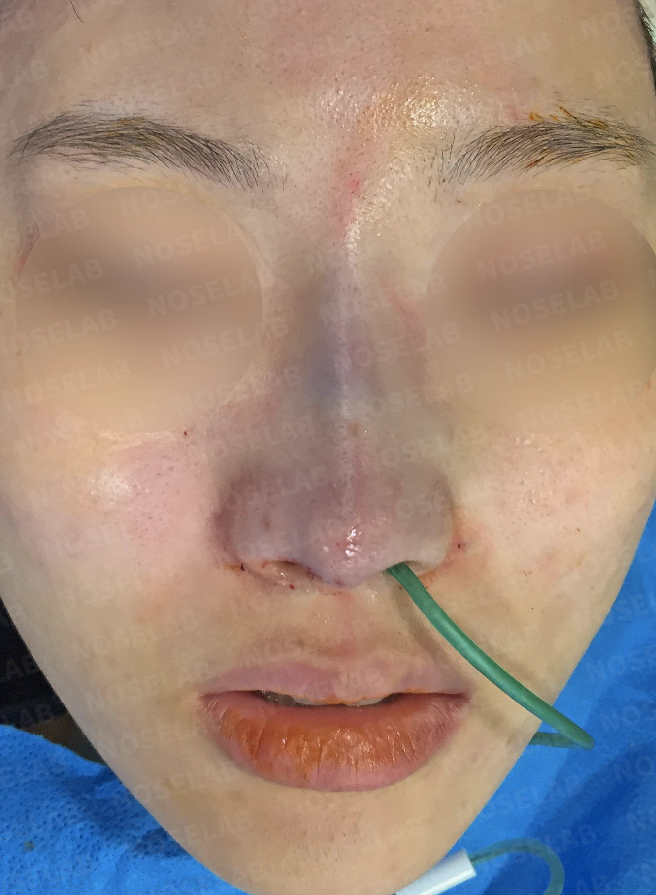 매부리코에 코의 휨과 비공 비대칭이 함께 오는 이유, 비중격 연골 교정은 어떻게 하나 — 수술 직후 0일 정면, 측면, 비스듬한 측면 직후 사진은 부기가 있는 상태로 최종 결과와 다를 수 있습니다.