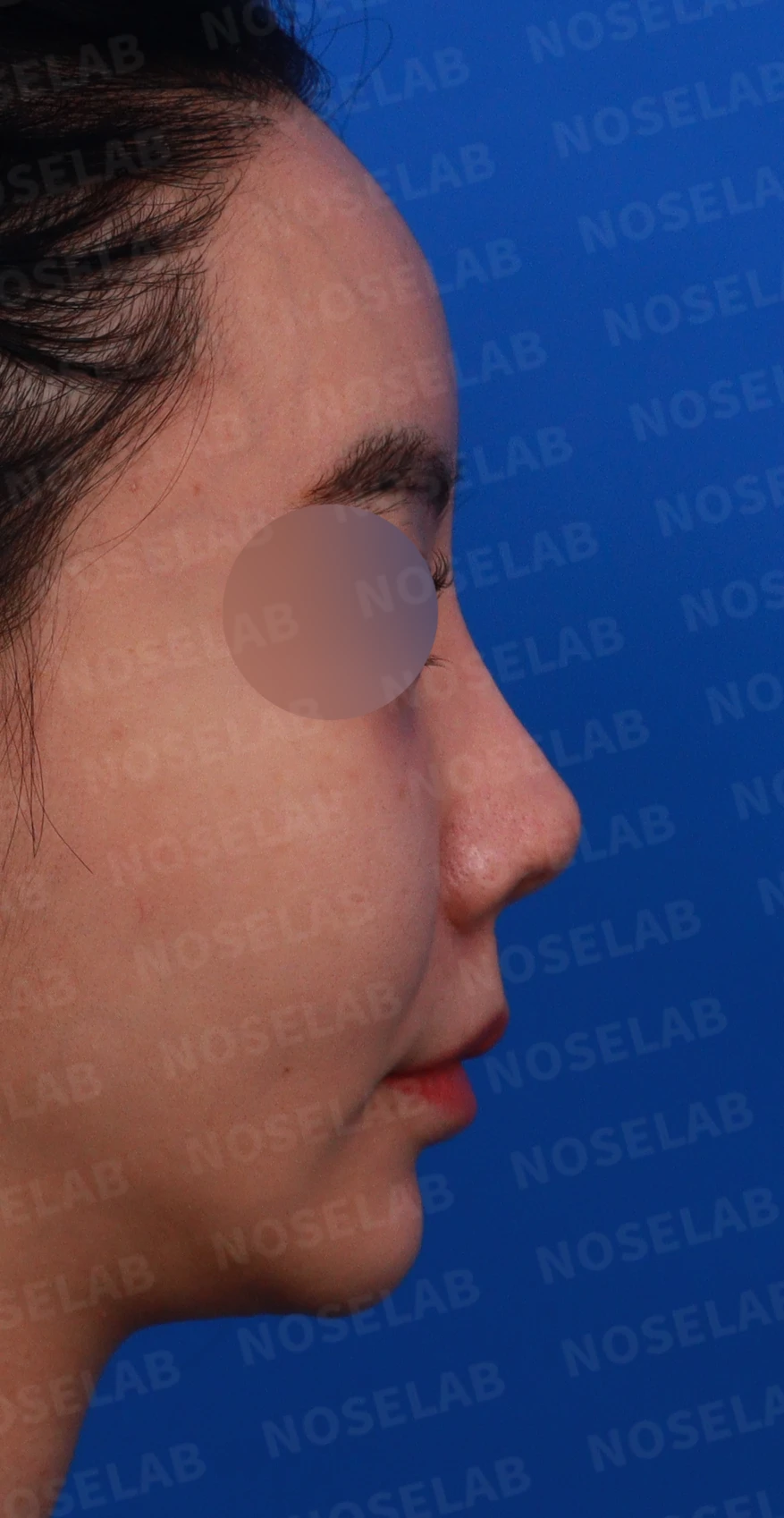 이식한 진피가 반복해서 흡수되는 이유, 재건은 어떻게 하나 — 디자인 상담 우측 비스듬한 측면, 측면, 비공 사진입니다.