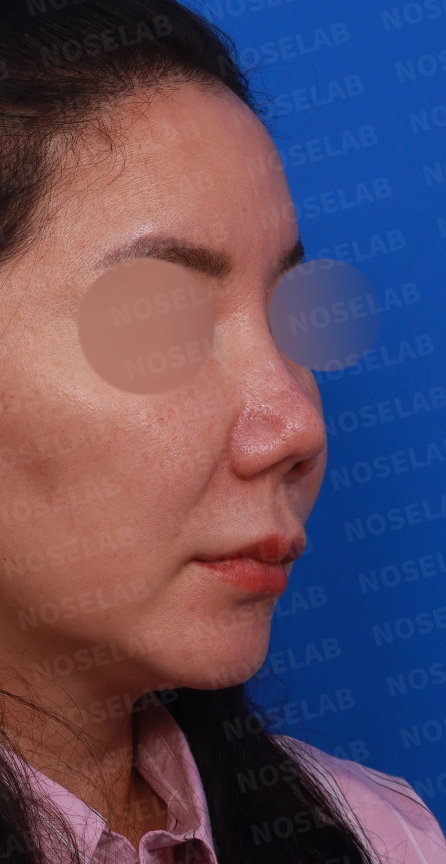 코끝이 찝히고 비주가 함몰되는 이유, 메드포어 제거와 재건은 어떻게 하나 — 디자인 상담 우측 비스듬한 측면, 측면, 비공 사진