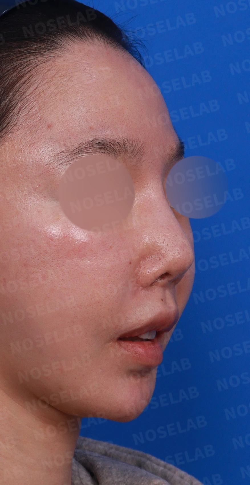 콧대가 뭉툭하게 퍼져 보이는 만성 이물 반응, 원인과 재건 방법 — 디자인 상담 우측 비스듬한 측면, 측면, 비공 사진