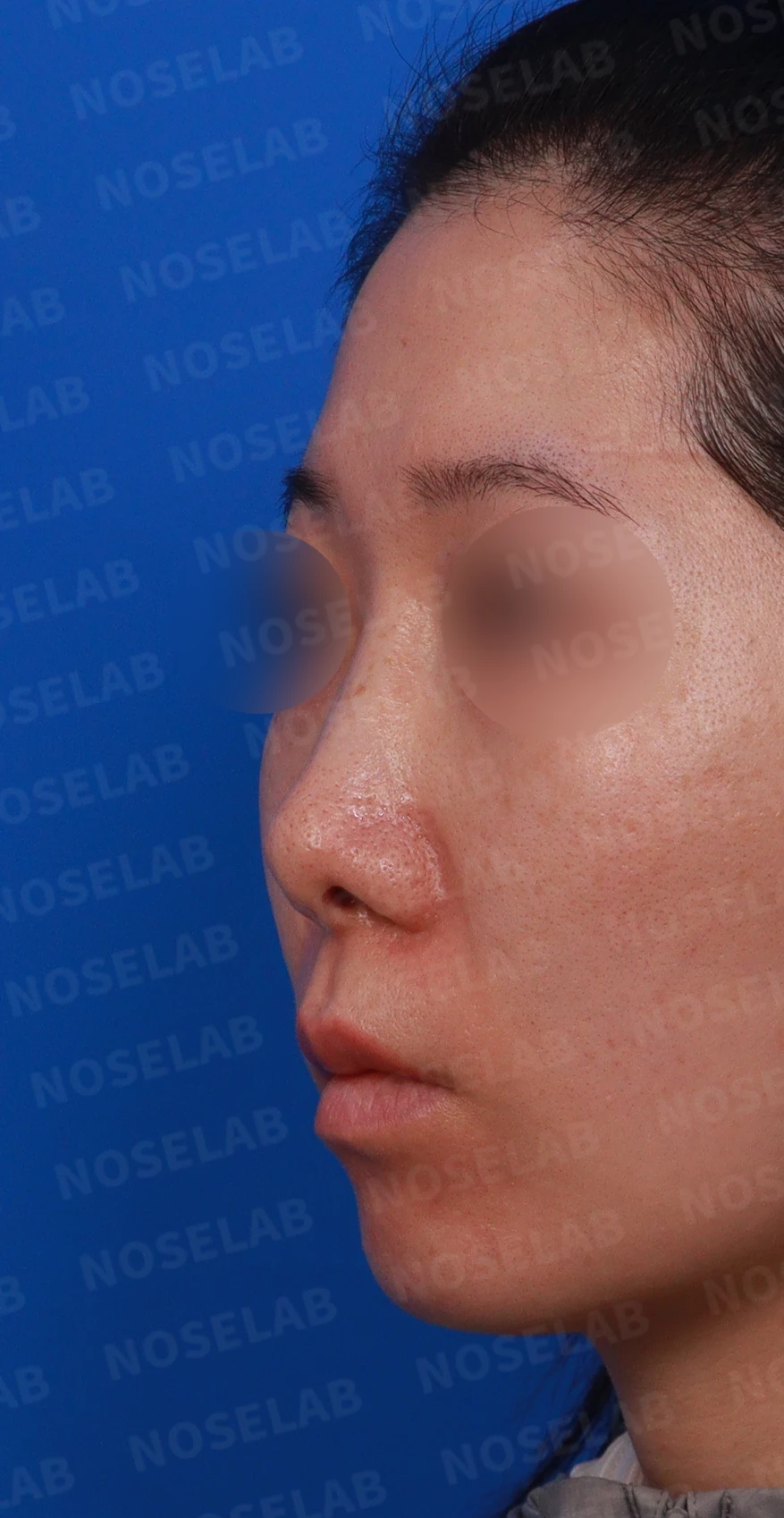 콧대 시작점이 높고 코가 휘어 보이는 이유, 자가 늑연골 교정은 어떻게 하나 — 디자인 상담 정면 , 비스듬한 측면 , 측면 사진입니다