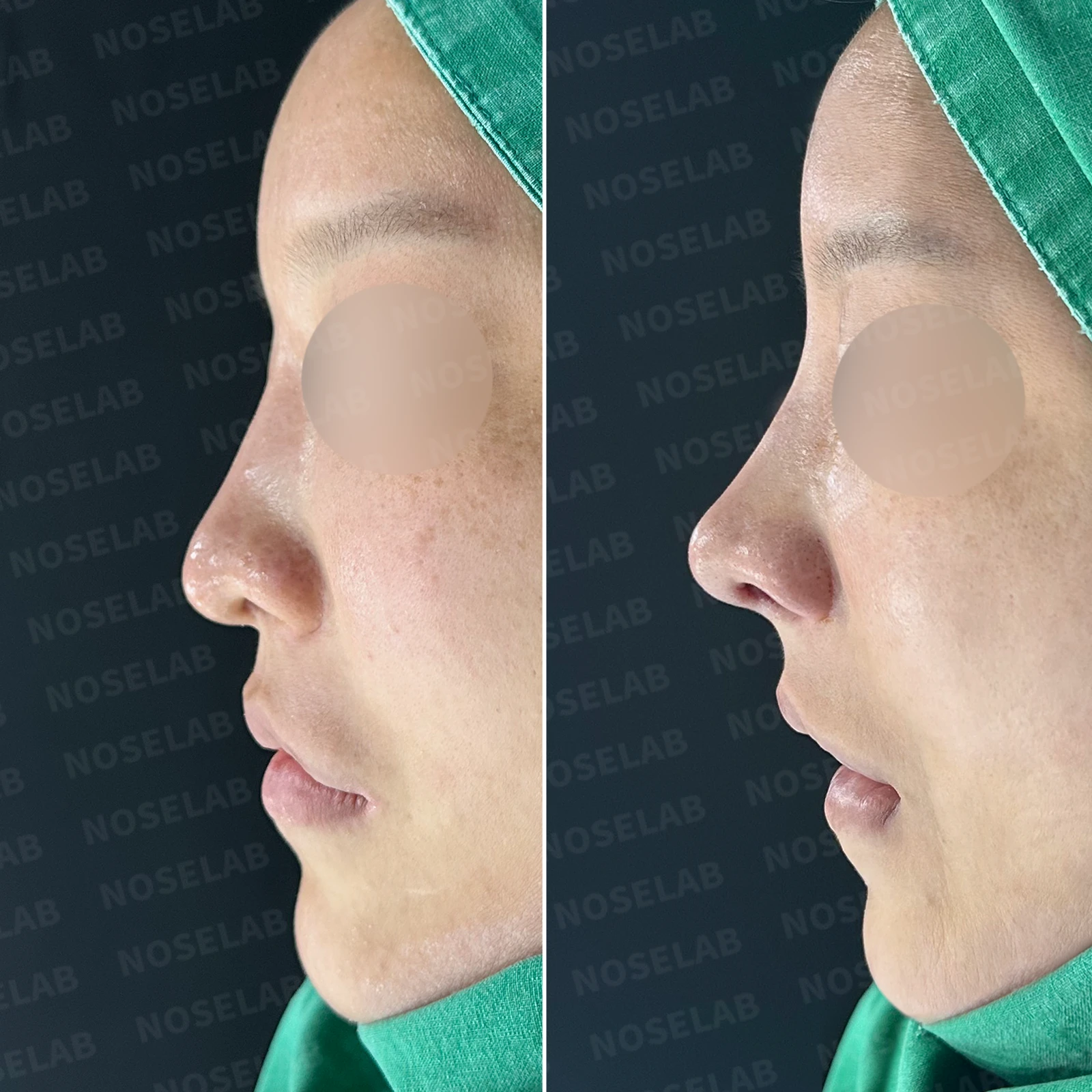 휜 코 교정과 코막힘 개선, 두 마리 토끼를 잡은 성공 사례 — 본문 사진 21
