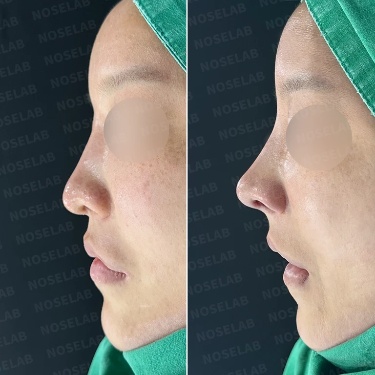 휜 코 교정과 코막힘 개선, 두 마리 토끼를 잡은 성공 사례 — 전후 비교