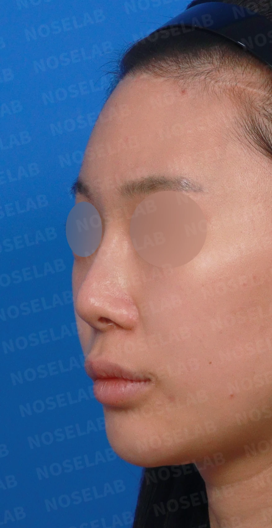비중격 천공이 생기면 무엇이 문제이고 어떻게 재건하나 — 디자인 상담 정면, 좌측 측면, 비스듬한 측면 사진입니다.