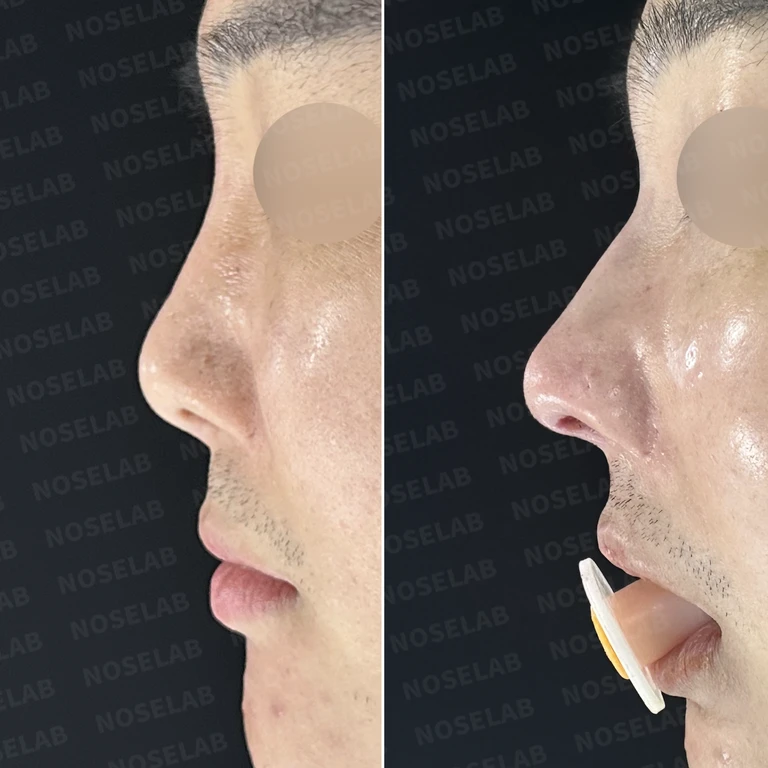 휜코 교정과 비공 비대칭, 자가늑연골로 바로잡은 코재수술 — 전후 비교
