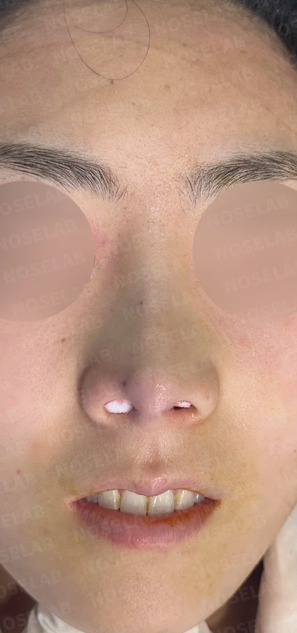 기능성 코성형·휘어진 비주 바로잡기 방법 — 수술 직후 0일 사진 90도 측면, 45도 측면, 정면 직후 사진은 부기가 있는 상태로 최종 결과와 다를 수 있습니다.