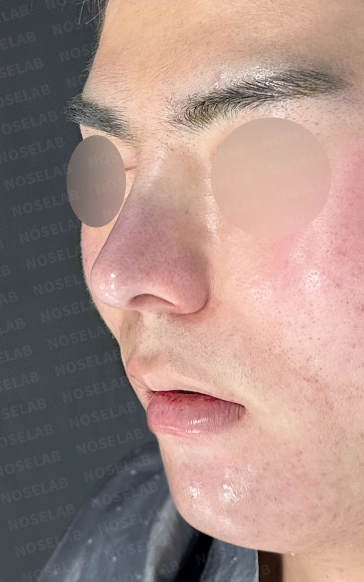 짧고 들려 보이는 작은 코, 왜 무리하게 높이지 않는가 — 수술 전 / 수술 직후 0일 직후 사진은 부기가 있는 상태로 최종 결과와 다를 수 있습니다.