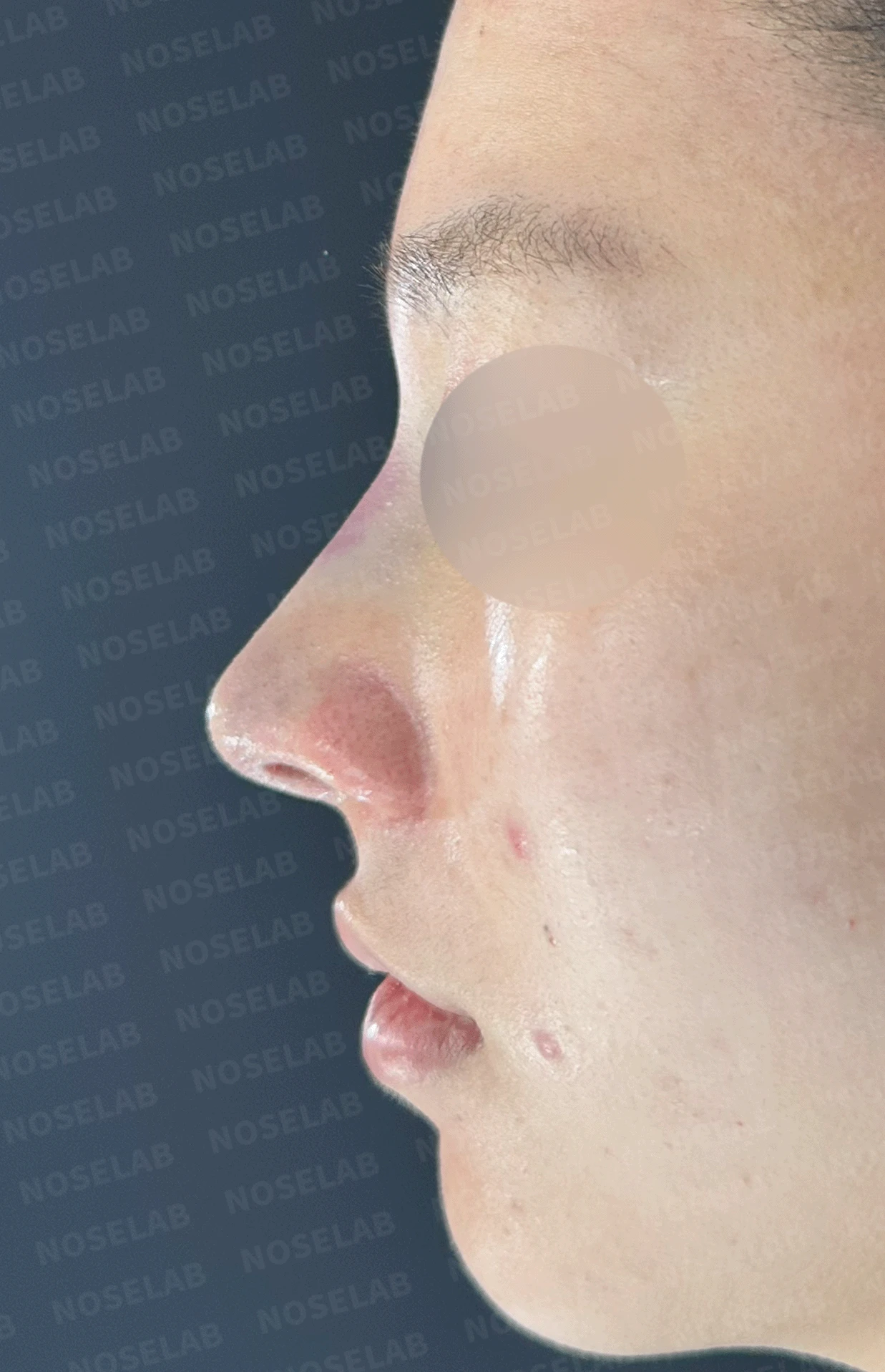 복코가 잘 교정되지 않는 이유와 이물질 제거 후 재건 방법 — 본문 사진 10