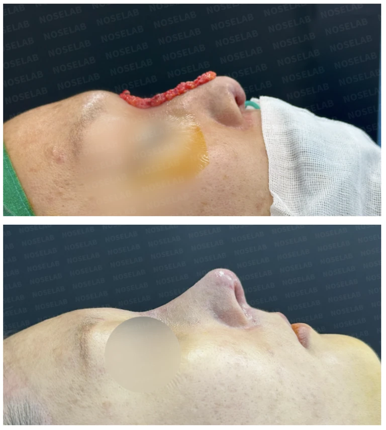 주입된 이물질을 제거하고 코를 재건하는 방법 — 전후 비교