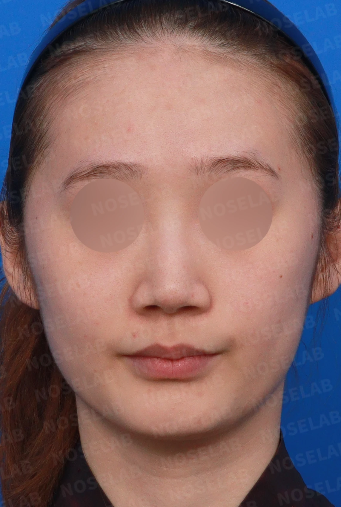 퍼진 코끝에 코막힘이 함께 오는 이유, 이물질 제거와 재건은 어떻게 하나 — 디자인 상담 정면, 좌측 측면, 비스듬한 측면 사진입니다.