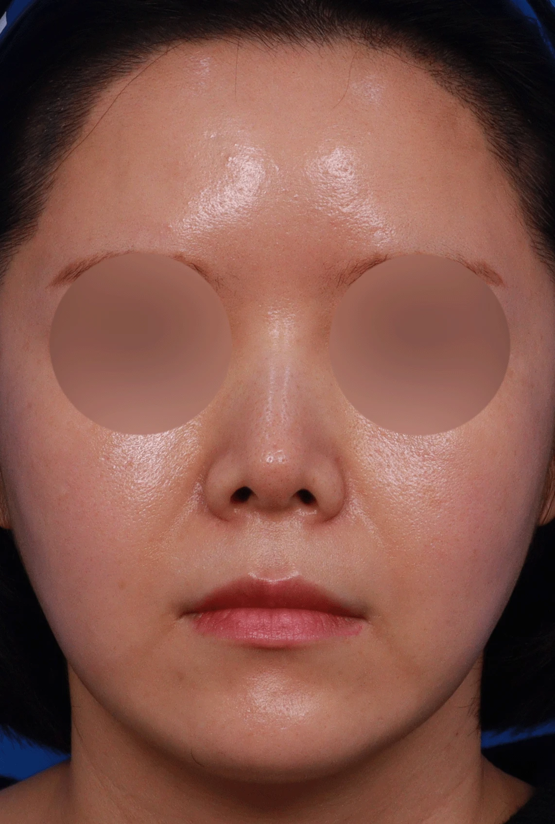 늑연골 석회화를 미리 확인해야 하는 이유와 휜코·짧은코 교정 방법 — 디자인 상담 정면 , 좌측 측면 , 비스듬한 측면 사진