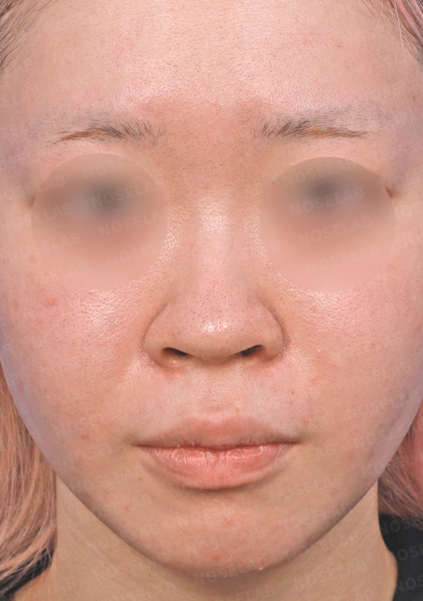 퍼진코, 복코 교정으로 균형 잡힌 이미지 완성 — 전(좌) 직후(우)