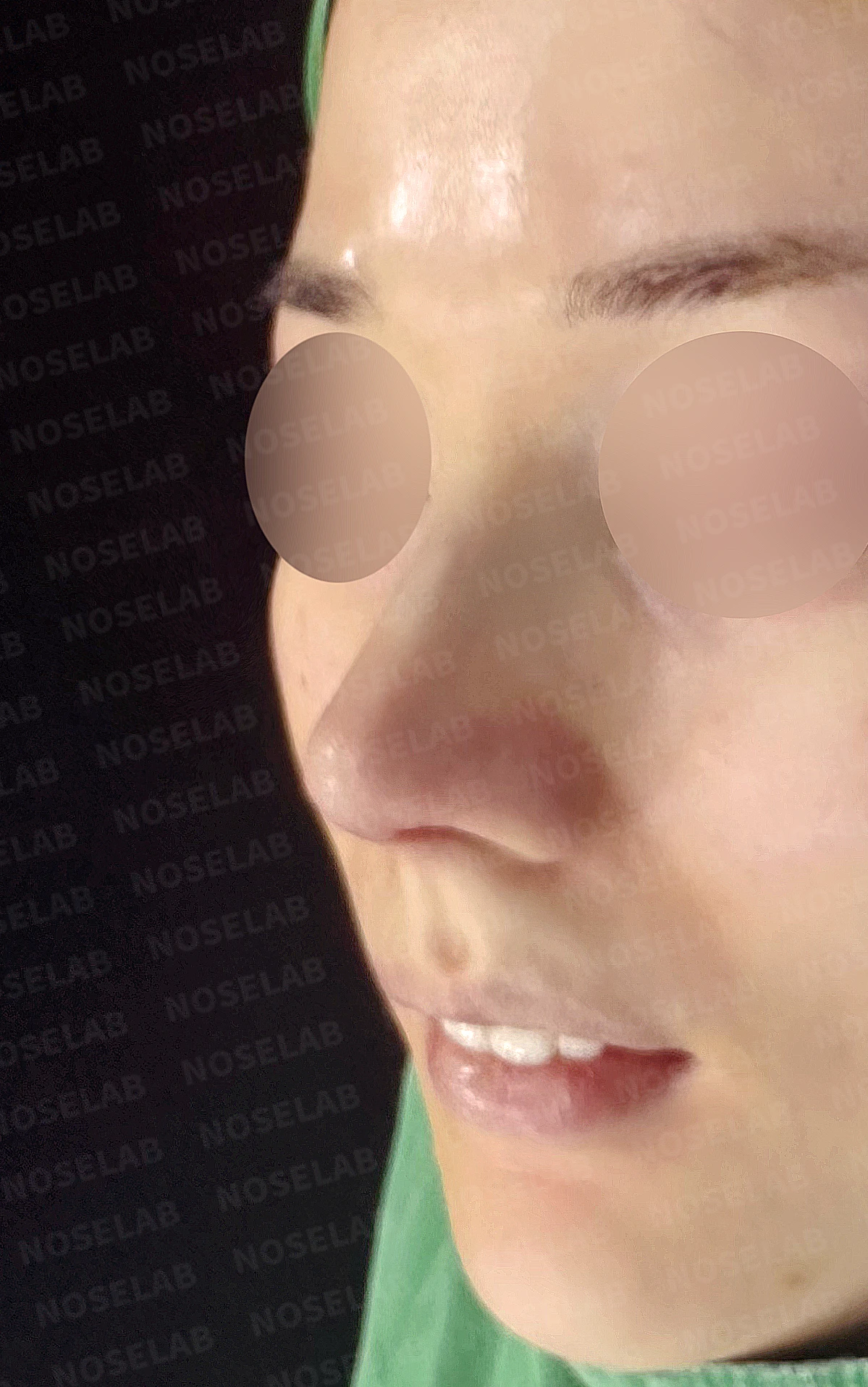 매부리코 교정, 처진 코끝을 오똑하게 바꾸는 비개방 코성형 — 직후 정면, 비스듬한 측면, 측면 사진입니다.