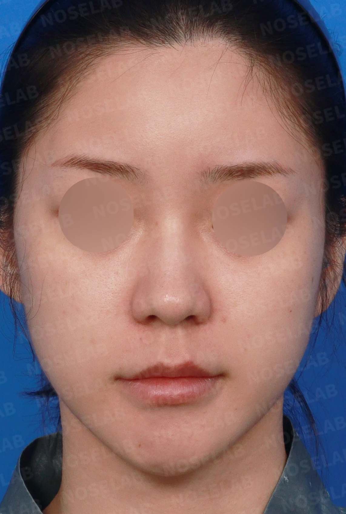 복코가 뭉툭하고 퍼져 보이는 이유와 코끝 입체감을 만드는 방법 — 디자인 상담 정면, 좌측 측면, 비스듬한 측면 사진입니다