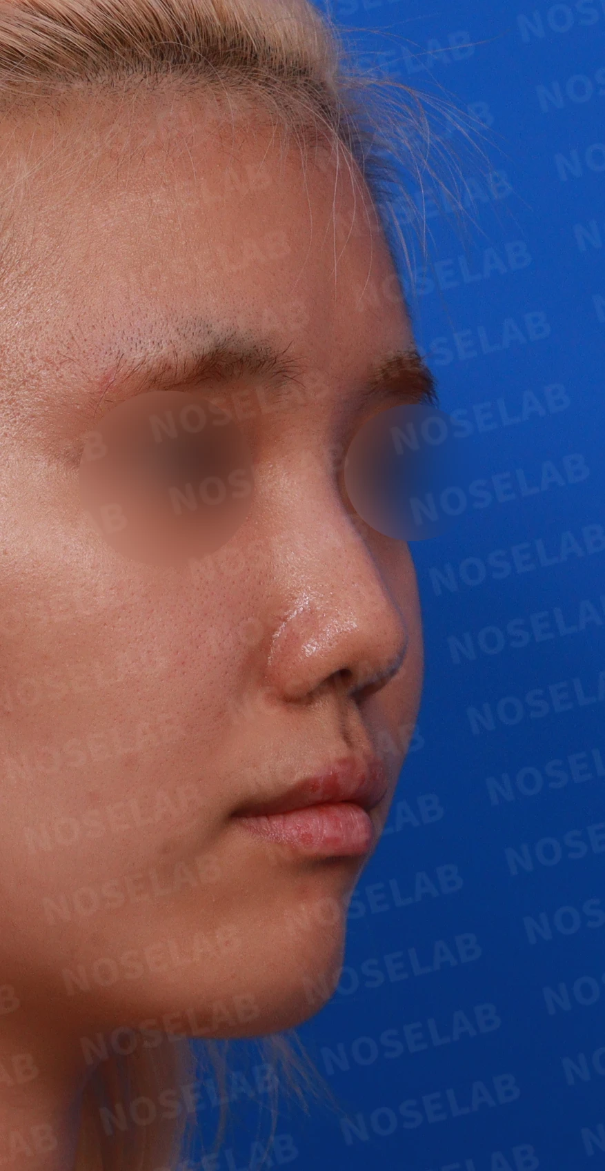 작고 뭉툭한 코는 어디까지 높일 수 있나 — 피부의 한계와 재건 방법 — 디자인 상담 우측 측면 , 비스듬한 측면 , 비공 사진입니다.