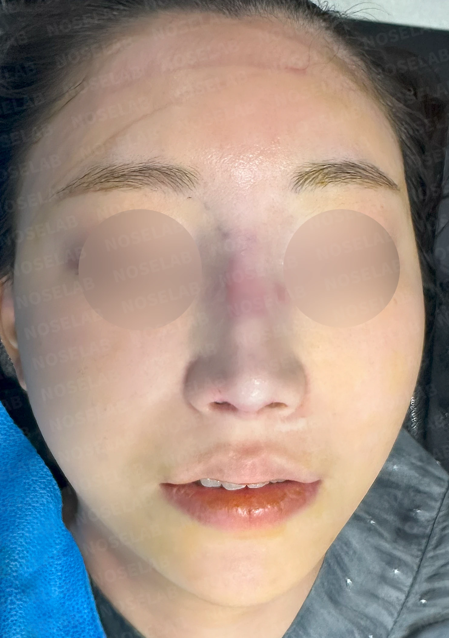필러와 실이 남아 있는 코, 제거 후 늑연골 재건은 어디까지 가능한가 — 수술 직후 0일 정면, 측면, 비스듬한 측면 사진 직후 사진은 부기가 있는 상태로 최종 결과와 다를 수 있습니다.
