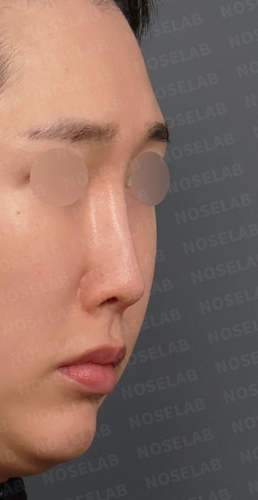 실리콘이 휘고 코가 길어 보이는 이유, 보형물 교체와 늑연골 재건은 어떻게 하나 — 디자인 상담 우측 측면, 비스듬한 측면, 비공 사진입니다.