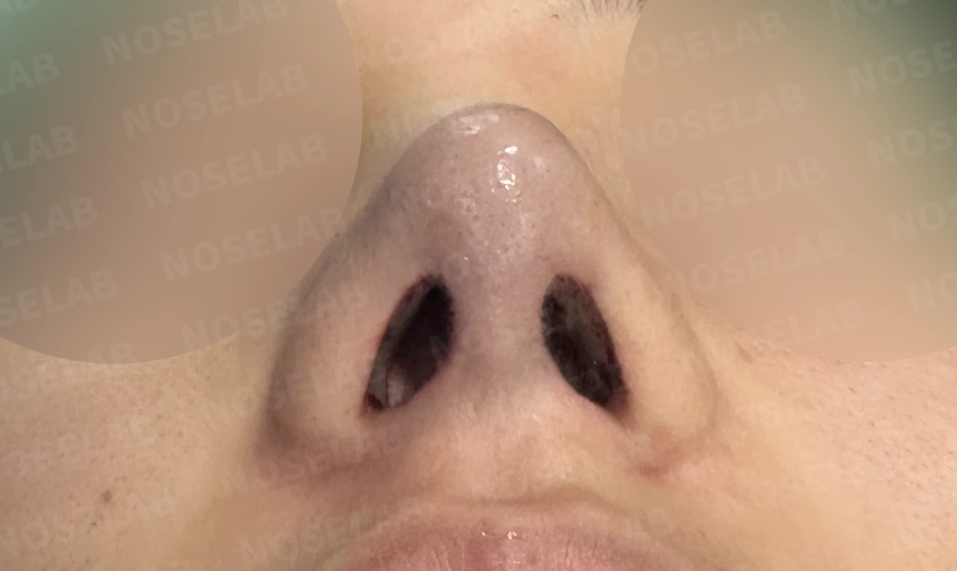 코끝 연골이 피부로 비쳐 보이는 이유와 진피 보강 방법 — 수술 직후 0일 비공 사진입니다. 직후 사진은 부기가 있는 상태로 최종 결과와 다를 수 있습니다.