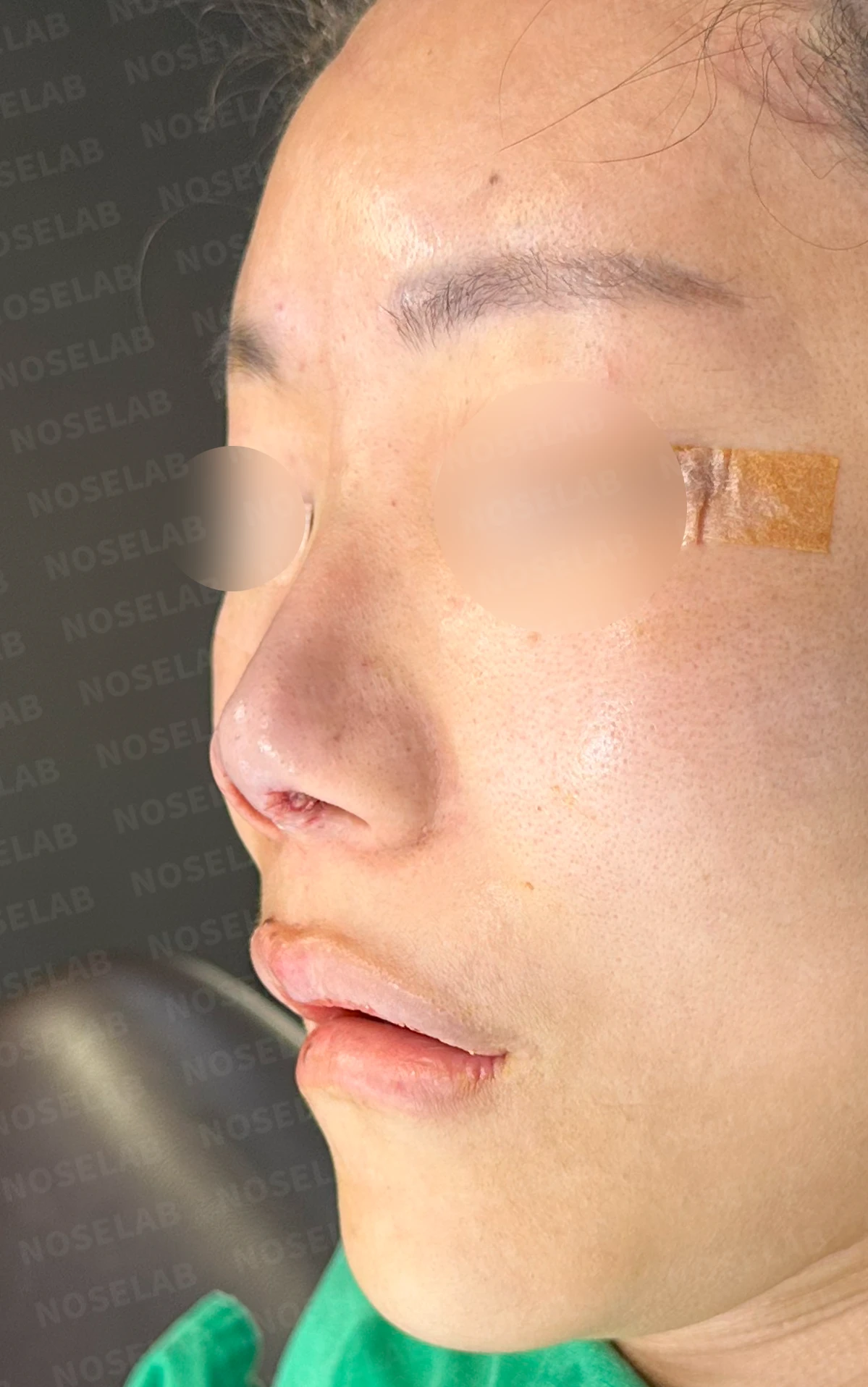 코성형 뒤 감염이 반복되는 이유, 염증 치료와 단계적 재건은 어떻게 하나 — 수술 직후 0일 정면 , 비스듬한 측면 , 측면 사진입니다. 직후 사진은 부기가 있는 상태로 최종 결과와 다를 수 있습니다.