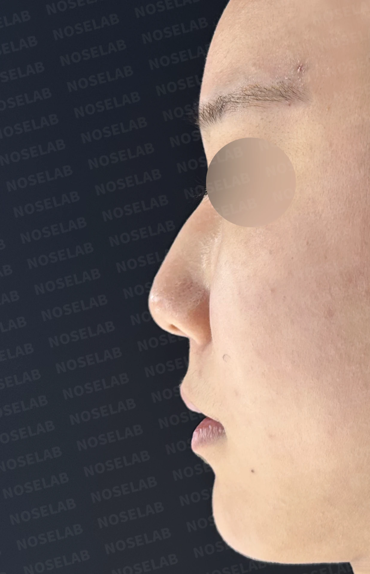 코필러 제거 후 자가늑연골 코성형, 처진 코끝과 메부리코를 자연스럽게 교정 — 전(좌) 직후(후)