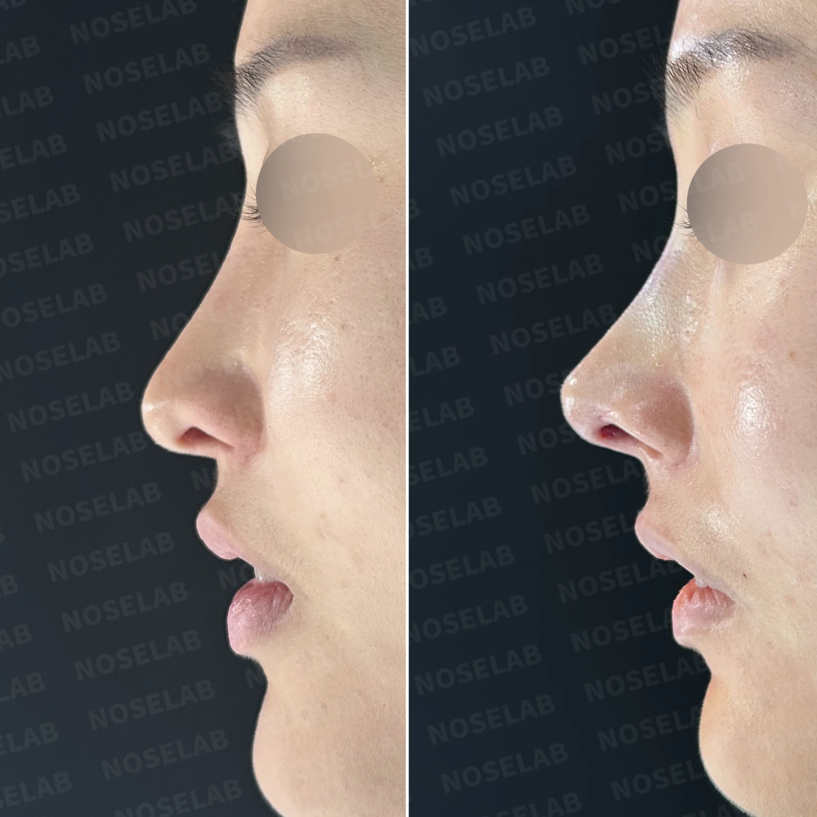 코성형 뒤 코끝이 처져 코가 길어 보이는 이유, 자가늑연골 코끝 재건 방법 — 본문 사진 20