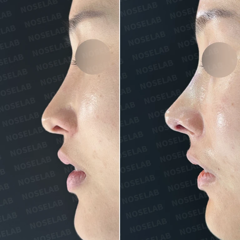길어 보이는 코, 자가늑연골로 오똑하고 자연스러운 코끝 완성 — 전후 비교