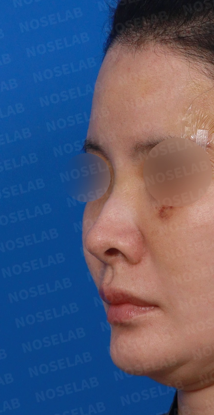 외상으로 코뼈가 부러지면 코가 어떻게 변형되고, 정복과 재건은 어떻게 하나 — 디자인 상담 정면, 좌측 측면, 비스듬한 측면 사진입니다.