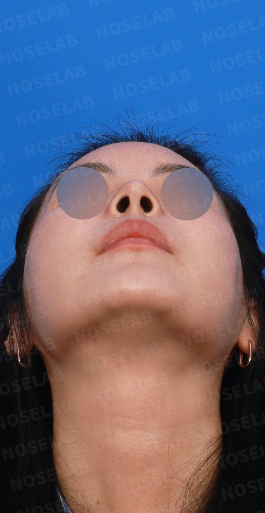 L자 실리콘 보형물이 비주 점막을 뚫기 직전까지 가는 이유, 제거와 자가늑연골 재건 방법 — 디자인 상담 우측 측면, 비스듬한 측면, 비공 사진