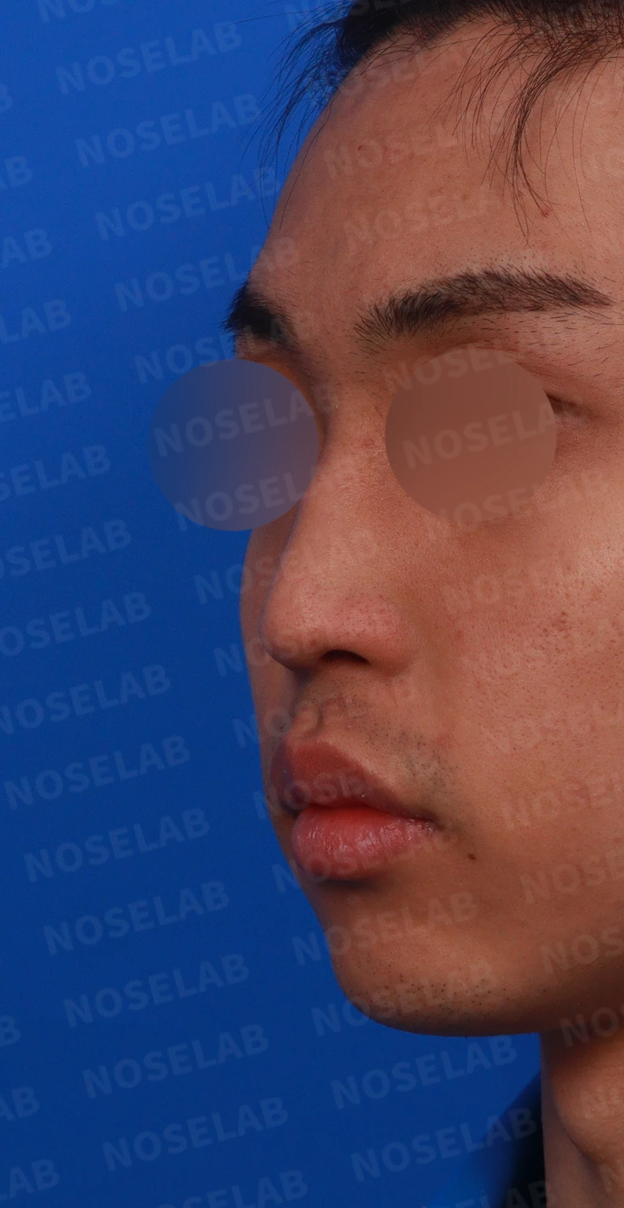 비염 수술 뒤에도 증상이 재발하는 이유, 휜 코를 함께 교정하는 방법 — 디자인 상담 정면, 좌측 측면, 비스듬한 측면 사진