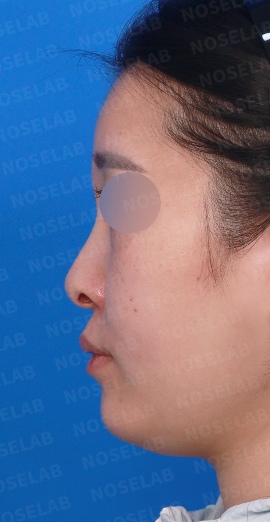 처진 비주 교정, 휜 코와 비공 비대칭까지 완벽하게 — 디자인 상담 정면, 좌측 측면, 비스듬한 측면 사진입니다.